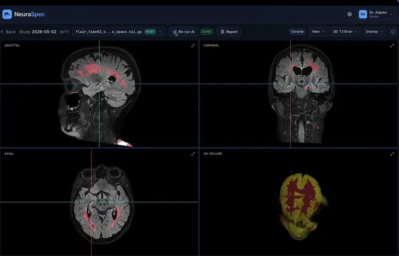 NeuraSpec: MS Lesion Detection & Tracking