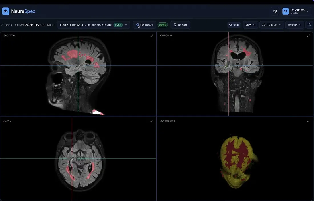 The NeuraSpec 4-pane viewer: sagittal, coronal and axial slices plus a 3D volume, with MS lesions highlighted in red.